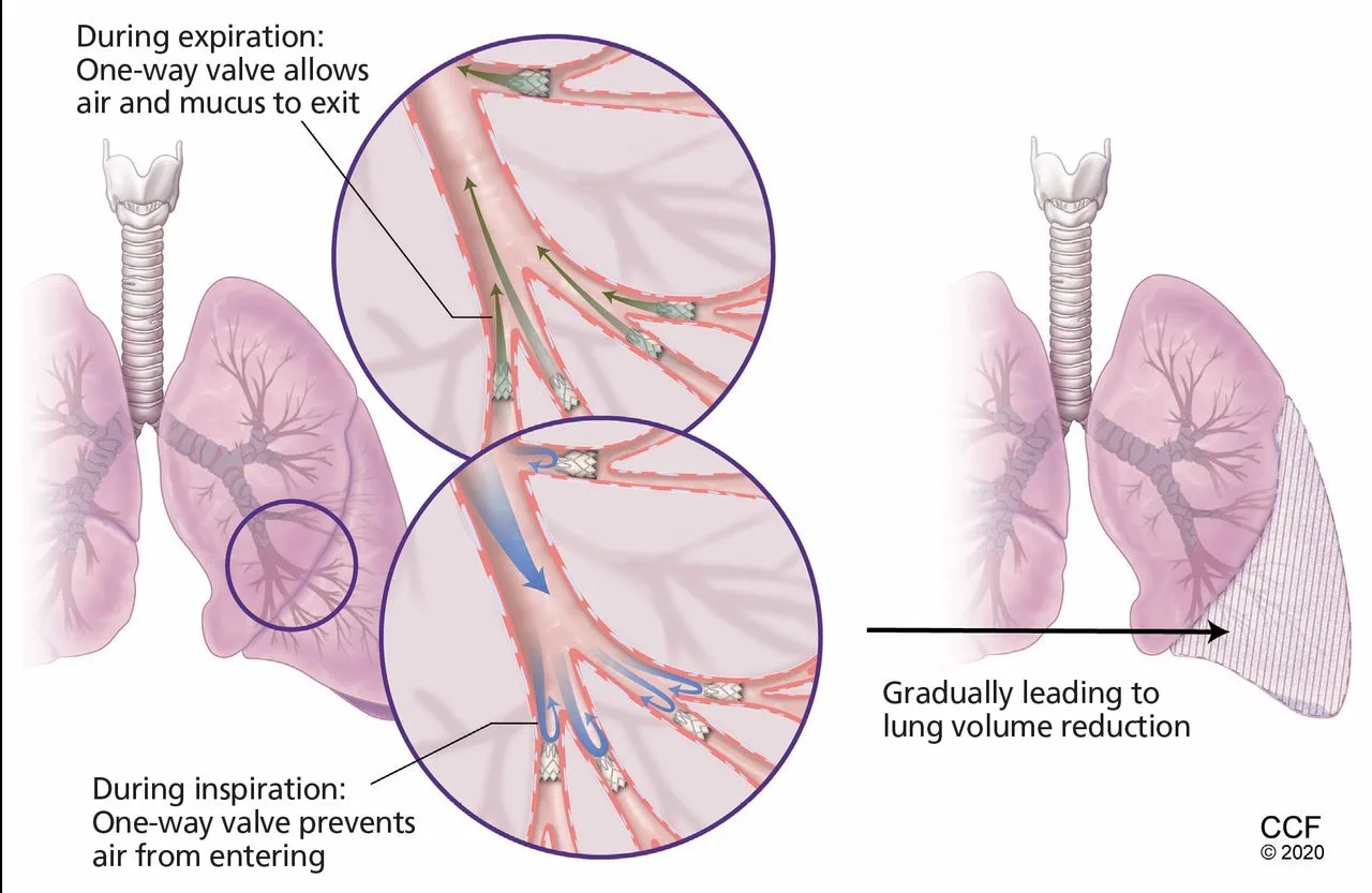 Karakoca Endobronchial Valves — active, cleanable, repositionable valve assembly